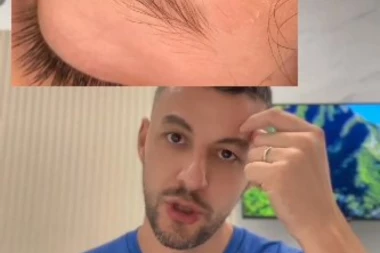 POGLEDAJTE KAKO JE SRPSKI HIRURG DUBOKU RASEKOTINU ĆERKI ZALEPIO SUPERLEPKOM! Suncobran joj razbio glavu u Grčkoj, morao brzo da reaguje! (VIDEO)