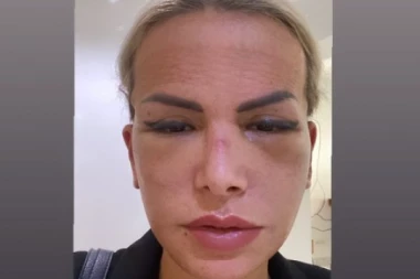 ZADRUGARKA NE PREPOZNAJE SEBE U OGLEDALU: Nakon operacije se potpuno izobličila, sada želi samo jedno!