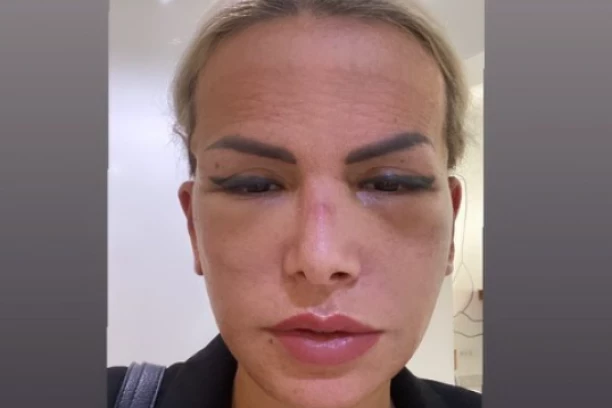 ZADRUGARKA NE PREPOZNAJE SEBE U OGLEDALU: Nakon operacije se potpuno izobličila, sada želi samo jedno!