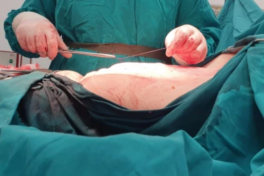 ŽENI IZVAĐEN TUMOR IZ STOMAKA TEŽAK 20 KG! Ivanka mislila da se ugojila, a kada su je lekari otvorili ostali su zapanjeni! Doktor Milinović objavio slike iz sale! (UZNEMIRUJUĆE)