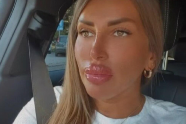 Dalila Dragojević pokazala nove usne