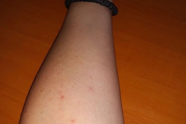 ANDRIJANI SE BERBA ŠLJIVA PRETVORILA U AGONIJU Sama sa sebe skinula više od 20 KRPELJA, doktorka joj izvadila još 103!