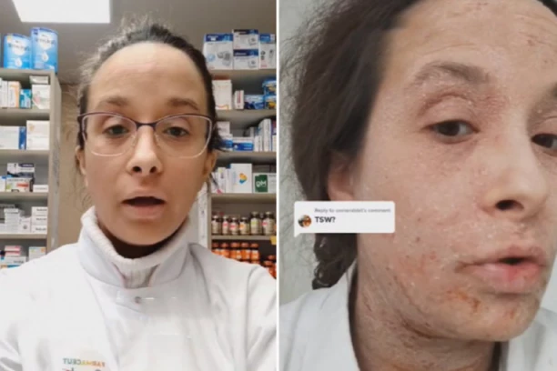 "OVA KREMA STVARA ZAVISNOST, KAD JE KORISTIŠ SIMPTOMI SE POVLAČE, ALI SE VRAĆAJU U GOREM OBLIKU": Farmaceutkinja Anđela stavljala  je ono što i VEĆINA, pa se desio UŽAS (FOTO/VIDEO)