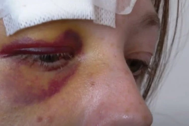 RAZBESNEO SE KAD MU JE ZATRAŽILA DEPOZIT Stanodavac divljački pretukao podstanarku pred decom! Spasao je muž: "Da mene nije bilo, tukao bi je DO SMRTI!"