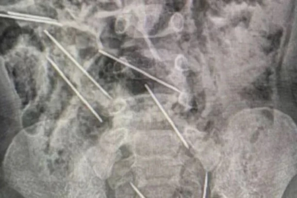 “VIDELA SAM SAMO DA IH NEMA”: Majka slučajno otkrila da joj je sin PROGUTAO OSAM IGALA! Usledila je borba za život i veliki obrt