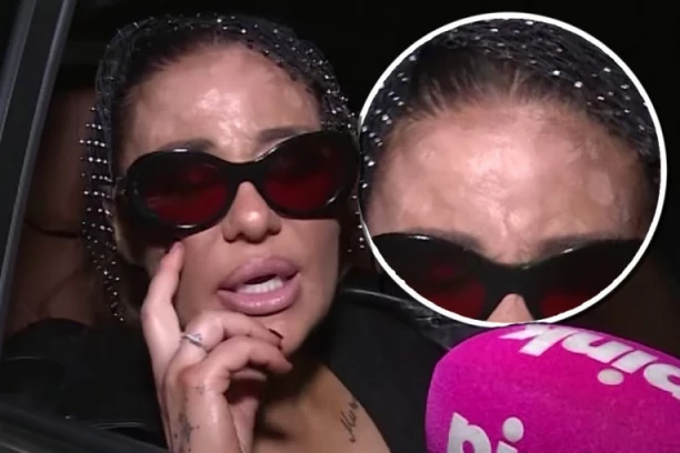 LICE ANE NIKOLIĆ PONOVO U KRATERIMA! Uznemirujuće izdanje pevačice, nove ožiljke pokušala da sakrije mrežicom (FOTO)