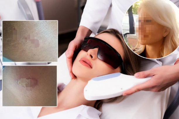 BEOGRAĐANKI U KLINICI SPRŽILI KOŽU TOKOM EPILACIJE! Tri nedelje nije mogla da sedi i ide na posao, A EVO ŠTA JE DOKTORKA PONUDILA!