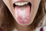 OTVORITE USTA I POGLEDAJTE SE U OGLEDALO: Ako OVO uočite možda bolujte od RAKA usne duplje!
