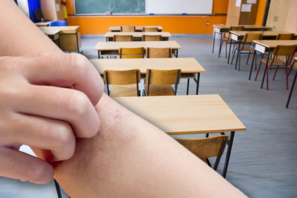 HITNO NALOŽENE MERE BEOGRADSKOJ ŠKOLI U KOJOJ SE POJAVILA ŠUGA! Jedan učenik se zarazio, svi roditelji zabrinuti!