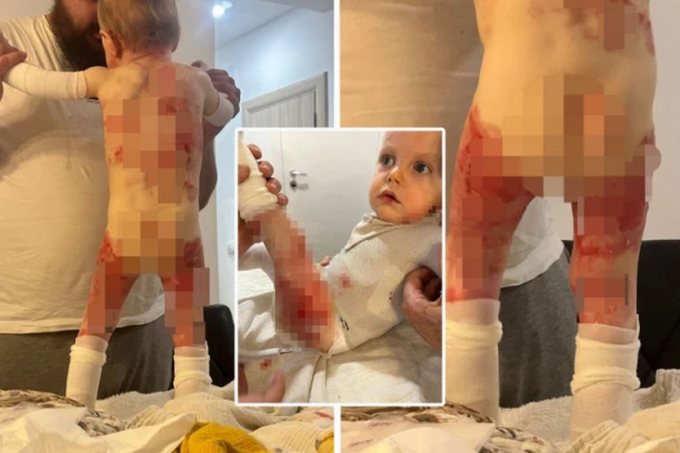 ''DEČAKU LEPTIRU'' POMAŽE TERAPIJA, RANE SVE MANJE": Dobre vesti o lečenju Viktora Putice stižu iz Amerike!