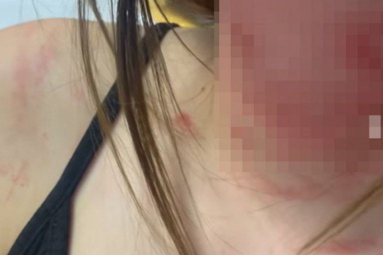 Sestra Uki Q, Sara H. i Damjan H. povrede