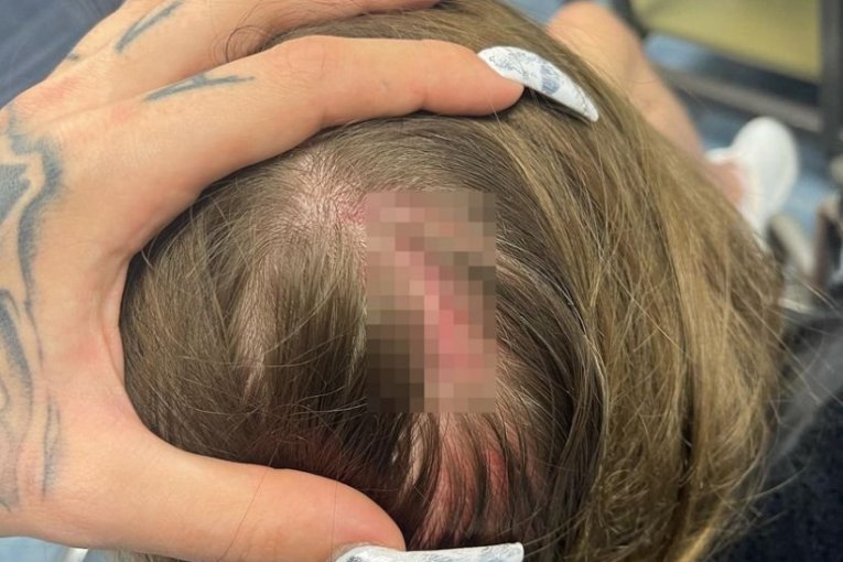 Sestra Uki Q, Sara H. i Damjan H. povrede