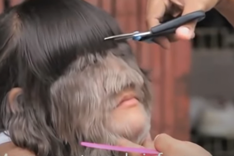 DEVOJKA SA LICEM MAJMUNA SE UDALA I OBRIJALA: Zbog onoga što ćete videti ostaćete u ŠOKU,  evo kako sada izgleda (FOTO)