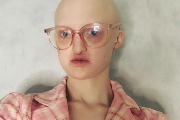 "ZBOG NJIH SAM HTELA DA SE UBIJEM": Vršnjaci je MALTRETIRALI jer ima retku BOLEST, a onda im se OVAKO osvetila!