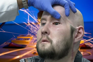 OVOM ČOVEKU STRUJNI UDAR UNIŠTIO JE VEĆI DEO LICA! Medicinsko čudo koje je dalo nadu  milionima SLEPIH LJUDI ŠIROM SVETA