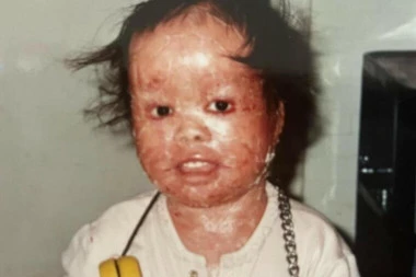 USVOJENA DEVOJČICA SA CRVENOM KOŽOM KOJU NIKO NIJE HTEO: Odrasla je u pravu ŠAMPIONKU (FOTO)