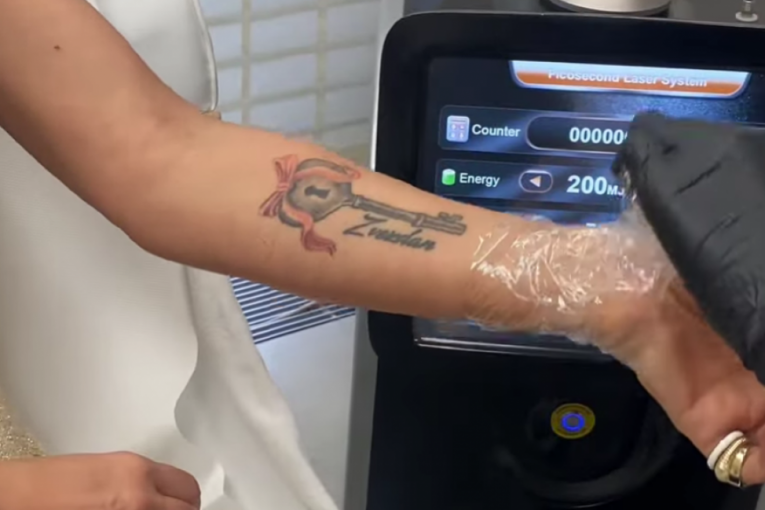 Ana Ćurčić skida tetovažu Zvezdanovo ime