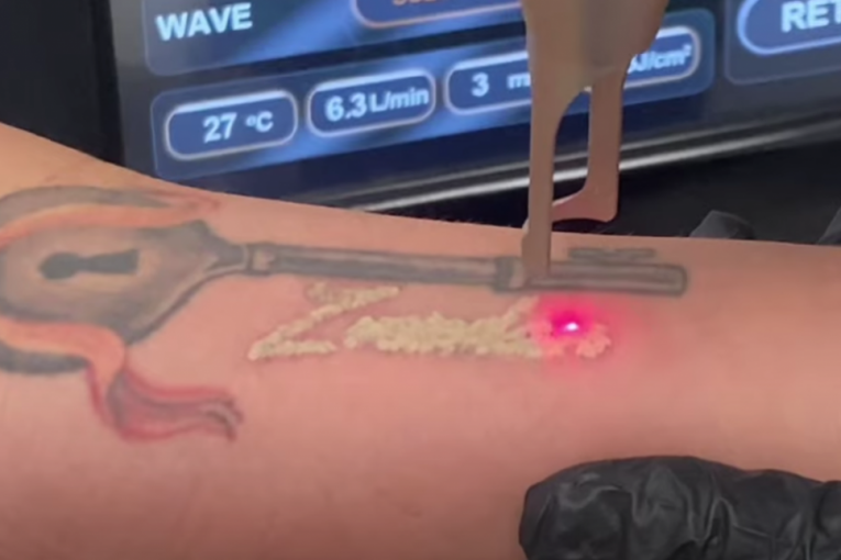 Ana Ćurčić skida tetovažu Zvezdanovo ime