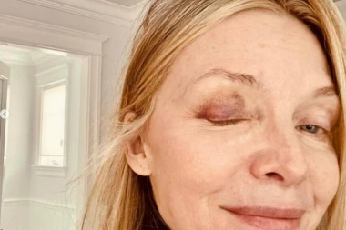 SLAVNA GLUMICA OTEKLA, CELO OKO JOJ JE MODRO: Zadobila strašnu povredu, slike uznemirile javnost!