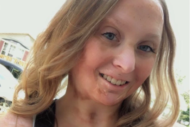 MAJKA HTELA DA JOJ UKLONI VAŠKE PA JOJ SPALILA LICE: Sve je pošlo po zlu jer joj je OVO namazala na glavu, a onda zapalila cigaretu!