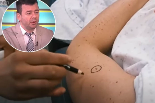 OVO SU PODMUKLI SIMPTOMI MELANOMA: Dermatolog otkrio koje MLADEŽE treba ukloniti i koje su to OPASNE promene na koži!