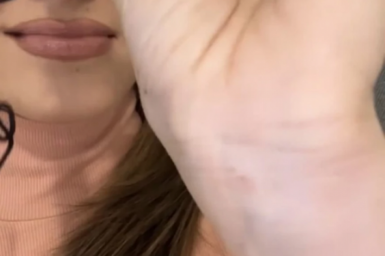 Sara Jo modrice nakon pada na dočeku Nove godine u Beogadu