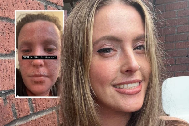 SVE JE POČELO KAO EKCEM, A ONDA JE USLEDIO HOROR! Unakaženu devojku izbegavali su na ulici, sve zbog jedne njene ODLUKE