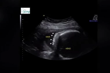 NA ULTRAZVUKU SU PRIMETILI ČUDNE TAČKICE: Majka zanemela od ŠOKA kada su joj lekari saopštili šta je TO!