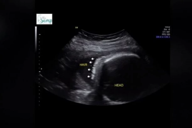 NA ULTRAZVUKU SU PRIMETILI ČUDNE TAČKICE: Majka zanemela od ŠOKA kada su joj lekari saopštili šta je TO!