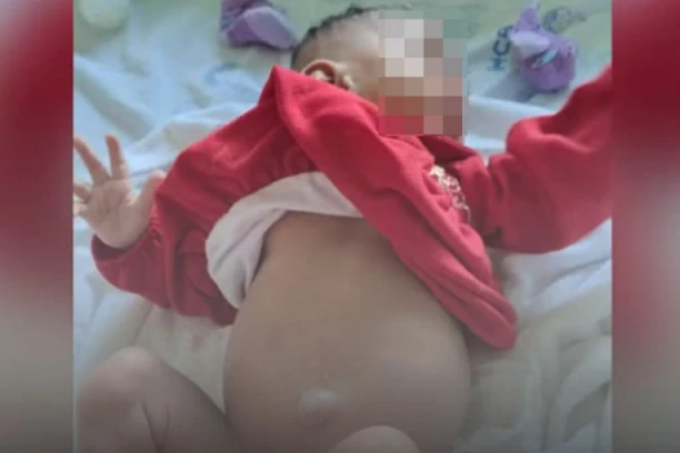 BEBA ROĐENA SA ČETIRI BUBREGA UŠLA JE U ISTORIJU: Reč je o ovoj RETKOJ ANOMALIJI, jedan joj odmah izvadili!