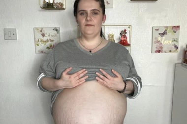 MISLILI SU DA JE TRUDNA, A U NJOJ JE RASLA "ŽIVOTINJA" VELIČINE DETETA: Jedva se kretala i disala, a onda joj je DOKTOR saopštio OVO!