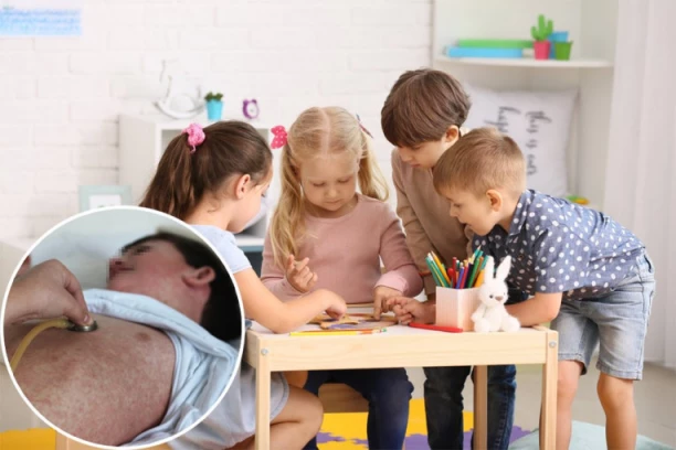 KOJA JE RAZLIKA IZMEĐU MALIH I OVČIJIH BOGINJA? Ovo je PRVI znak zaraze, a evo zašto su JEDNE duplo opasnije!