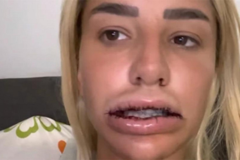 Aleksandra Nikolić operacija usana