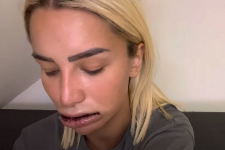 Aleksandra Nikolić operacija usana