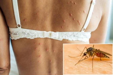 KAKO DA ZNATE DA VAS NISU NAPALI NEVIDI?! Evo kako da ih prepoznate - Ubod ne osetite, a posledice mogu da budu SMRTONOSNE