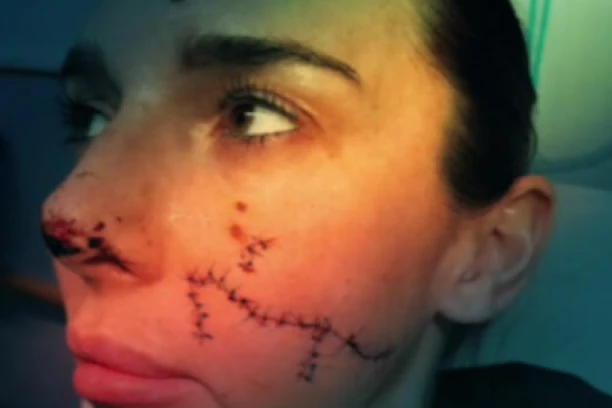 "VIDELA SAM MESO KAKO MI VISI SA LICA" Devojka brutalno isečena u toaletu noćnog kluba (VIDEO)