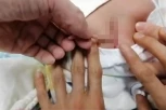 NOVOROĐENČETU IZ KIČME PORASLO NEŠTO JEZIVO I DUGAČKO 10 CM: Lekari ODBIJAJU da ga uklone, sad je kao ŽIVOTINJA