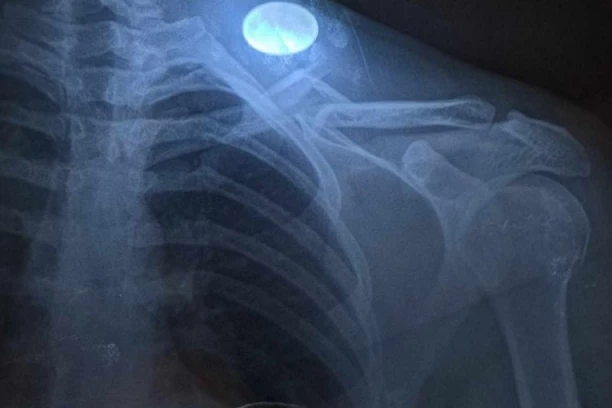 UŽAS: Utakmica je ostala u senci teške povrede fudbalera - šestostruki PRELOM ključne kosti!