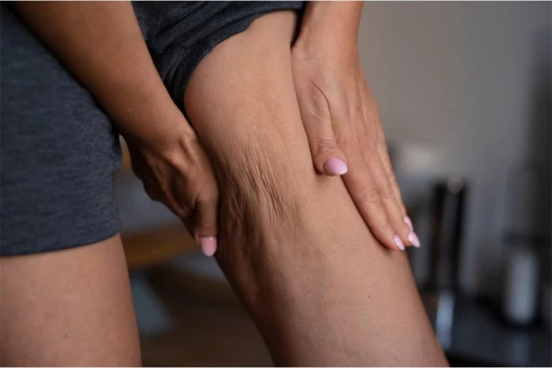 OVAJ ČAJ ĆE IZBRISATI CELULIT KAO GUMICOM: Jednostavnije je nego što možete da zamislite, do LETA STE RAKETA!