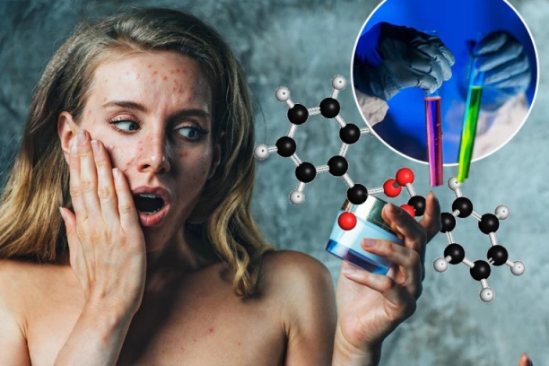 KREME ZA AKNE IZAZIVAJU RAK: Američka labaratorija otkrila JEZIVU ISTINU