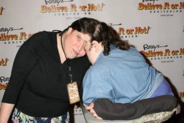 TRAGIČNA SUDBINA NAJSTARIJIH SIJAMSKIH BLIZANACA: Delili 30 odsto mozgova i opovrgnuli lekare!