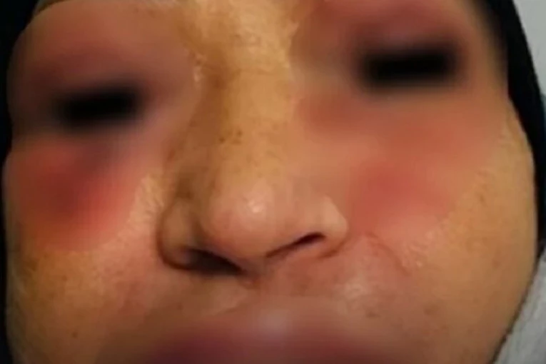 LICE JOJ SE DEFORMISALO, MISLILA JE DA ĆE UMRETI: Evo šta se dogodilo ženi kada je uzela lek koji Srbi SVAKODNEVNO GUTAJU