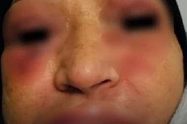 LICE JOJ SE DEFORMISALO, MISLILA JE DA ĆE UMRETI: Evo šta se dogodilo ženi kada je uzela lek koji Srbi SVAKODNEVNO GUTAJU