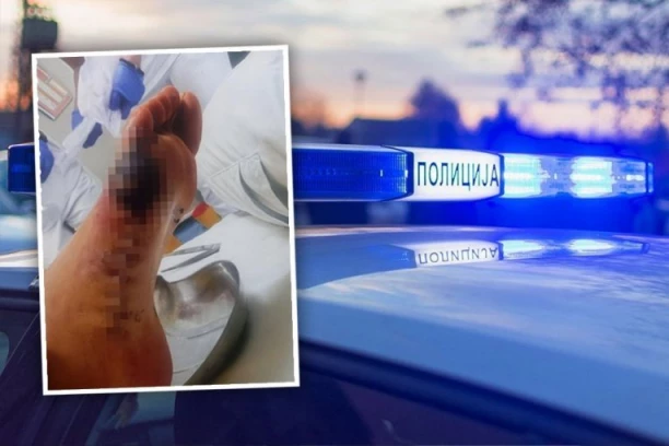 (UZNEMIRUJUĆE FOTOGRAFIJE) Uhapšeni lekar i kozmetičar iz Beograda: Pacijentu POGREŠNO lečili stopalo! POGLEDAJTE KAKO SADA IZGLEDA NOGA!