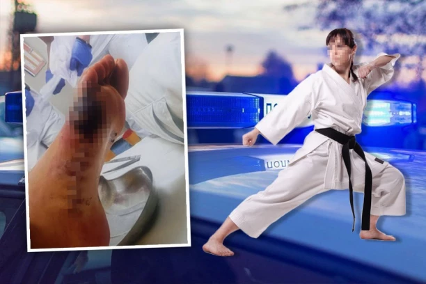 OVAKO JE UMALO STUDENTKINJA OSTALA BEZ STOPALA: Urolog i kozmetičar joj ogoleli kost, a obećali rutinsku intervenciju- RODITELJI NIŠTA NISU ZNALI