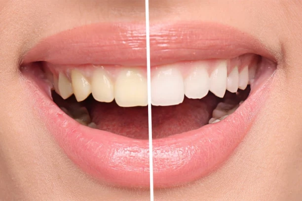 ZBOG OVOGA ŠTO RADITE ČETKICOM ŽUTE ZUBI: Stomatolog UPOZORAVA - mala greška može mnogo da vas košta!