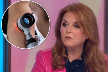 AKO SIMPTOMI TRAJU OVOLIKO JAVITE SE LEKARU: Vojvotkinja obolela od raka kože, a ovo su ZABRINJAVAJUĆI ZNACI bolesti, rano uočavanje je KLJUČ