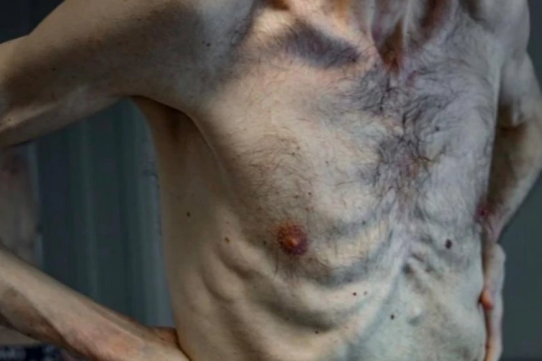 PROVEO DVE GODINE U RUSKOM ZAROBLJENIŠTVU: Od Romana Goriljuka ostali samo kosti i koža, oglasio se savetnik Zelenskog