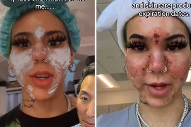 PROIZVODIMA ZA NEGU KOŽE SPALILA LICE! Jedna greška je mnogo koštala, OVO pogledajte na AMBALAŽI!