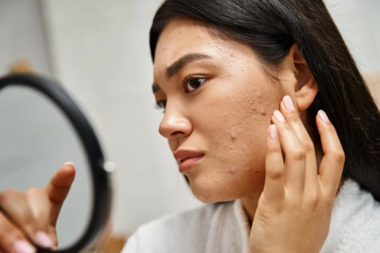 OVA PROMENA NA KOŽI MOŽE UKAZATI NA RAK: Nije primetna, pogledajte kako izgleda (VIDEO)